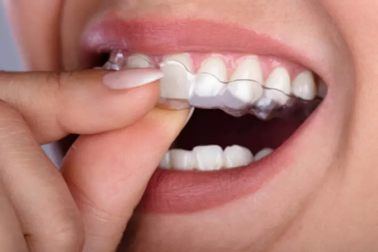 Clear Aligners (Invisalign, etc.)
