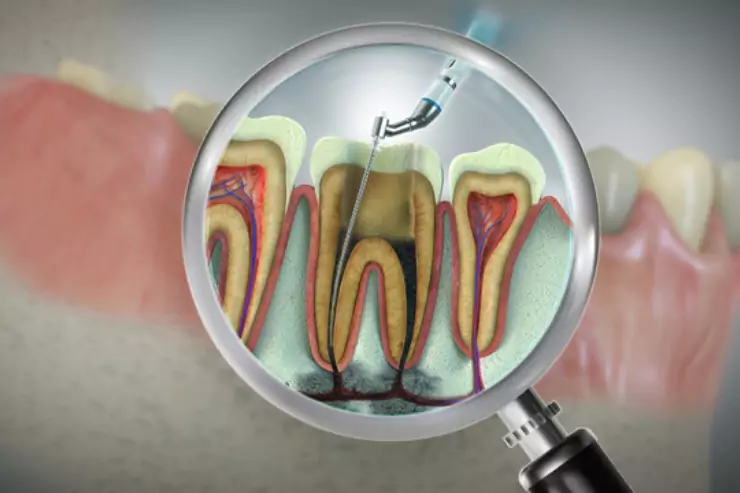 Endodontic Retreatment