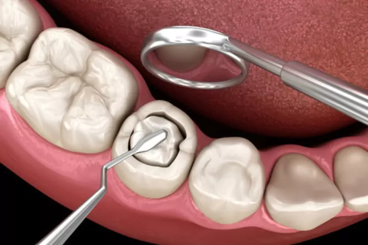 Fillings