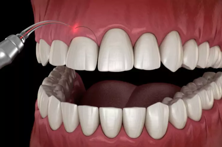 Gum Contouring