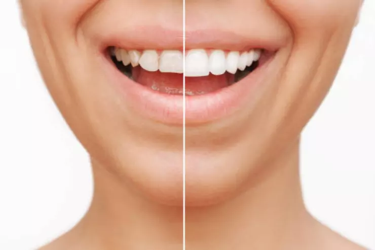 Smile Design