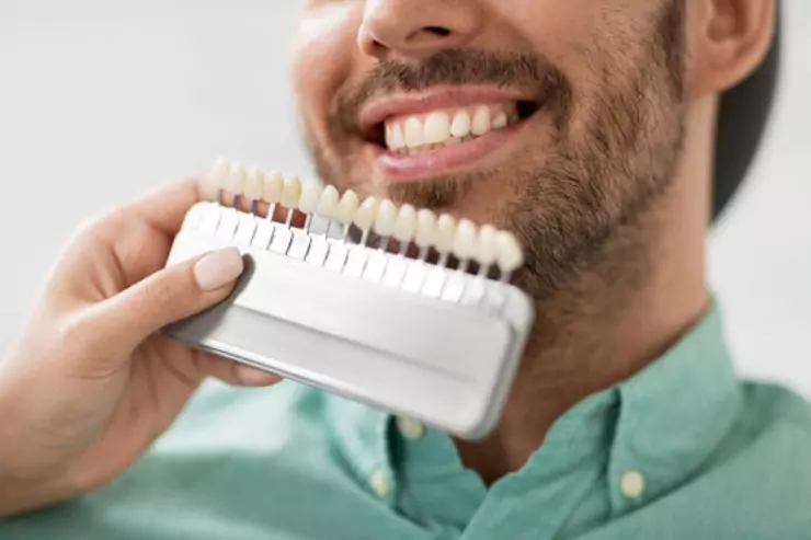 Veneers (Porcelain, Composite)
